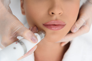 Facial Hair Removal