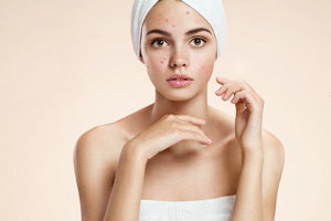 Acne Treatment