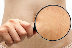Stretch Marks Treatment
