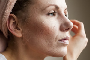Acne scars