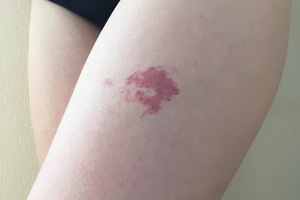 Hemangiomas