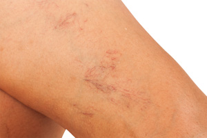 Spider Veins