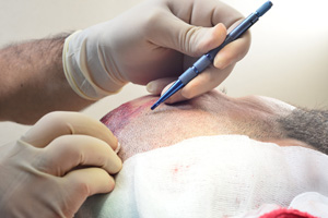 FUT Hair Transplant Technique