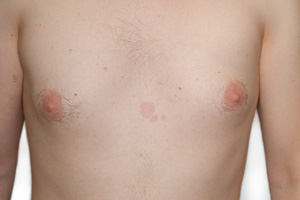 Skin Mycosis