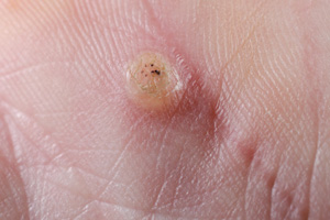 Warts