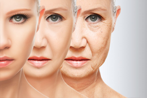 Microneedling RF